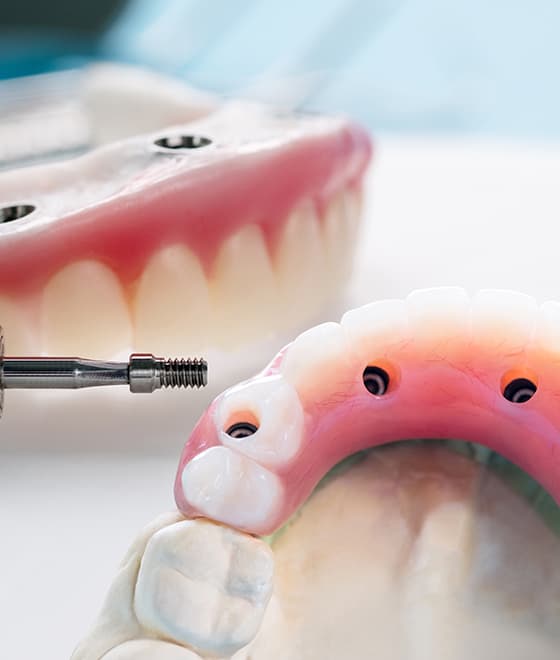 Implant-Supported Dentures