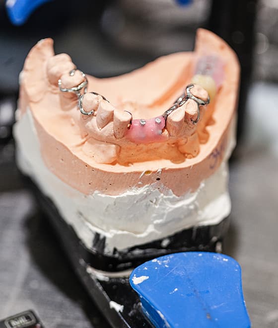 Partial Dentures